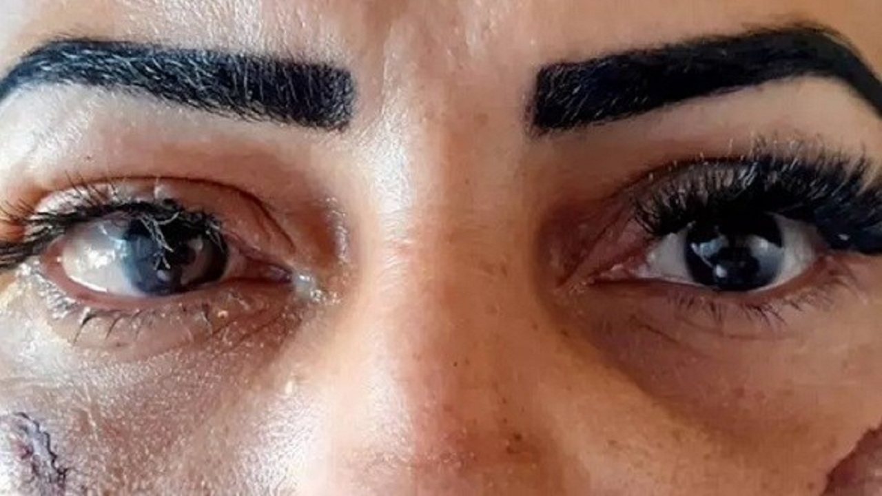 زنی در جستجوی زیبایی خود را نابینا کرد