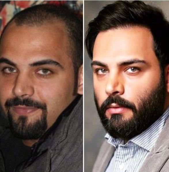 عکس‌های احسان علیخانی قبل از کاشت مو لو رفت