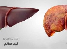 اگر کبد چرب دارید، این غذاها را حتما مصرف کنید