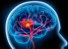در مواجهه با سکته مغزی چه کنیم؟