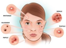 شستشوی بیش از حد صورت دلیل بروز آکنه است؟