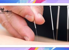 طب سوزنی در کاهش وزن موثر است