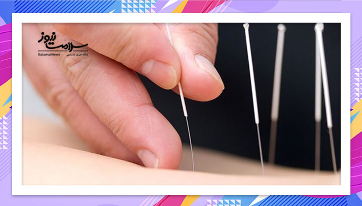 طب سوزنی در کاهش وزن موثر است