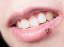 ۷ خوراکی مفید برای کاهش خطر انتقال ویروس تبخال